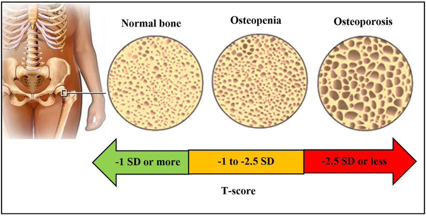osteoporotic trauma normal bone